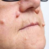 Skin Cancer in Hyderabad