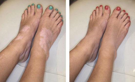 Skin Treatment And Skin Pigmentation In Hyderabad