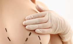 Breast Lift Surgery