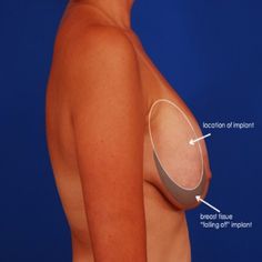 sagging-breasts-reduction-treatment-in-hyderabad