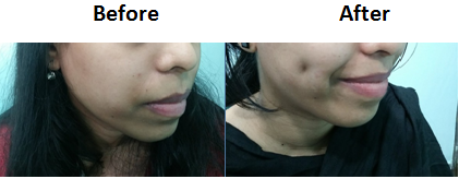 dimple-creation-surgery-in-hyderabad