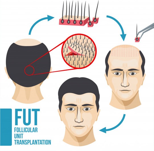 hair-transplant-is-fue-honeymoon-over-