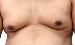 Gynecomastia Treatment