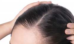 Hair Growth Treatment