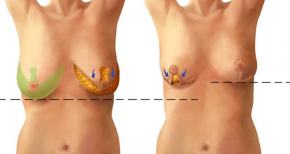 breastlift-and-breast-reduction-in-hyderabad