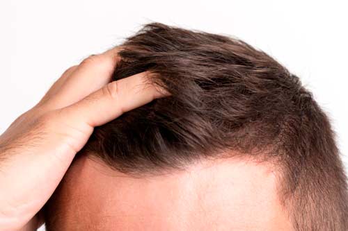 Hair Transplant Hyderabad