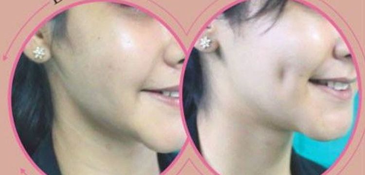 dimple-creation-surgery