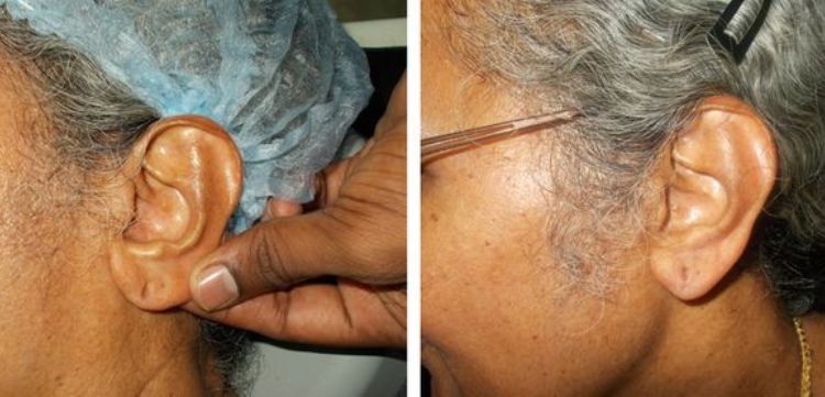 ear-lobe-surgery