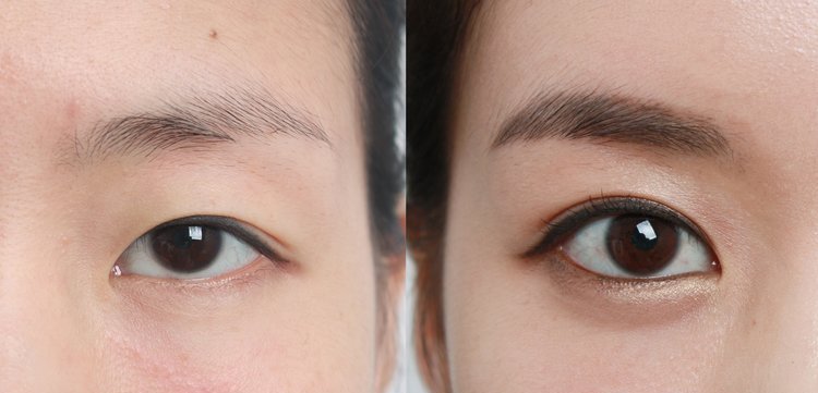 eye-lid-surgery