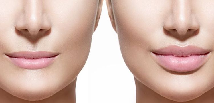 lip-augmentation-surgery