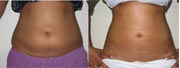 Liposuction Before and After