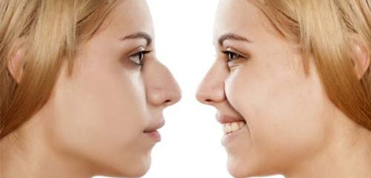 Nose Surgery Before and After