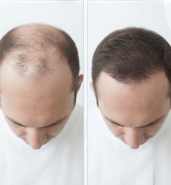 autologous conditioned serum  result