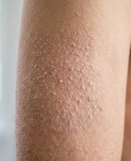 bumpy dry skin treatment