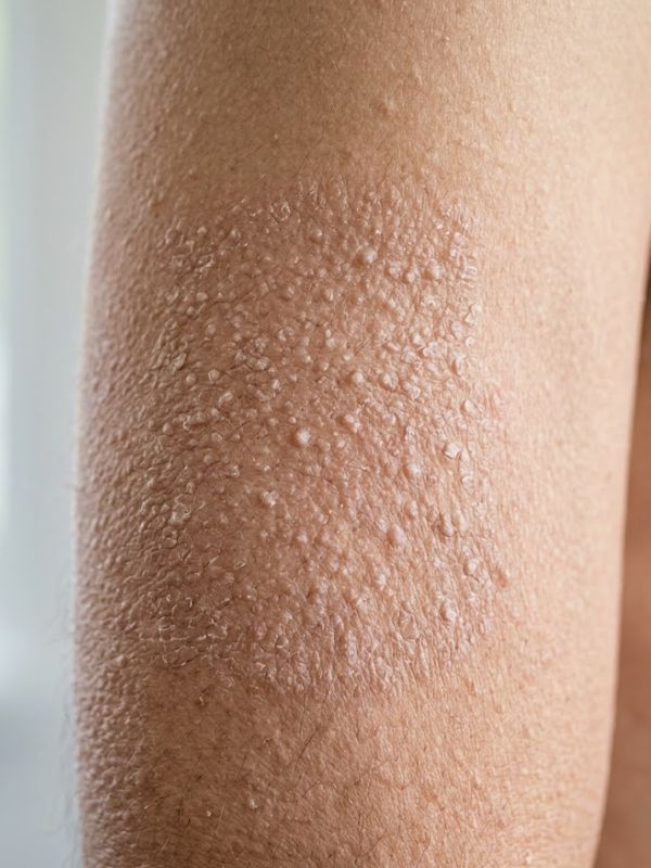 bumpy dry skin treatment
