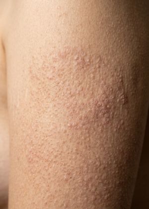 bumpy dry skin procedure
