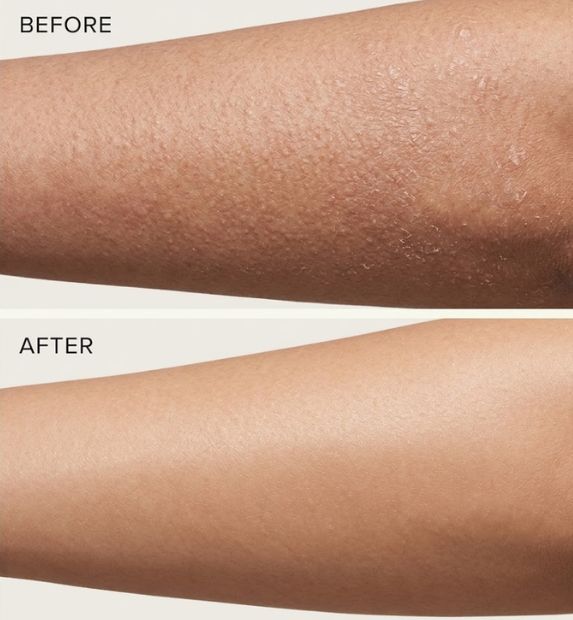 bumpy dry skin