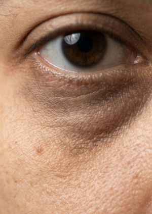 dark circles areas
