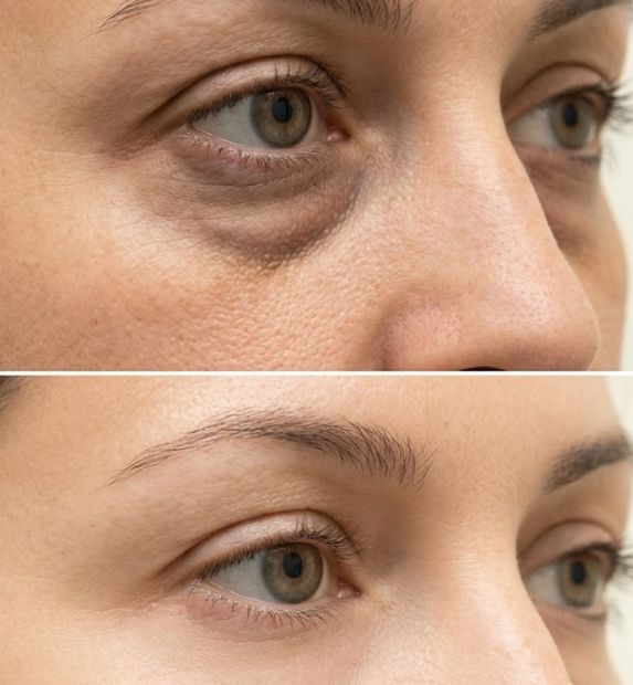dark circles