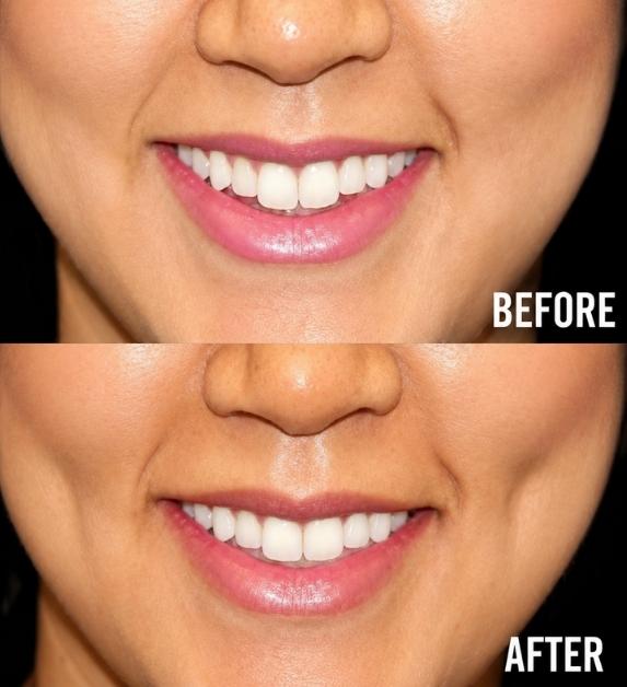 Dimple Creation Surgery