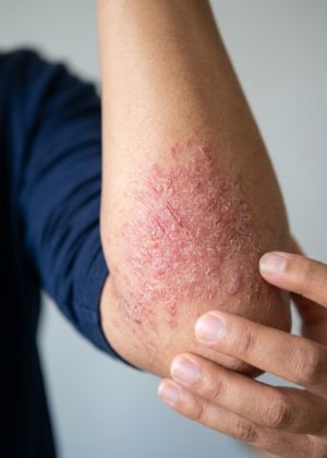 eczema treatment