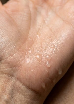 excessive sweating areas