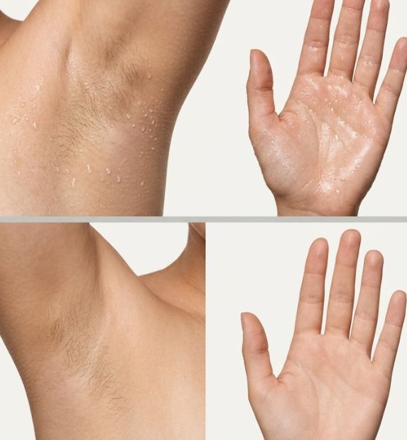 excessive sweating