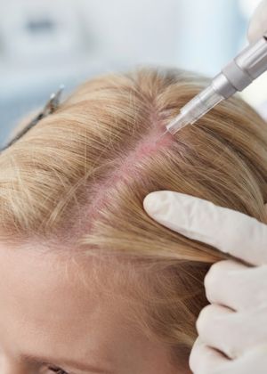 exosome hair areas