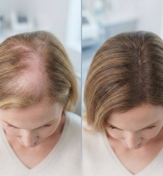 exosome hair therapy result