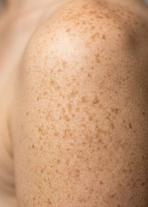 freckles areas