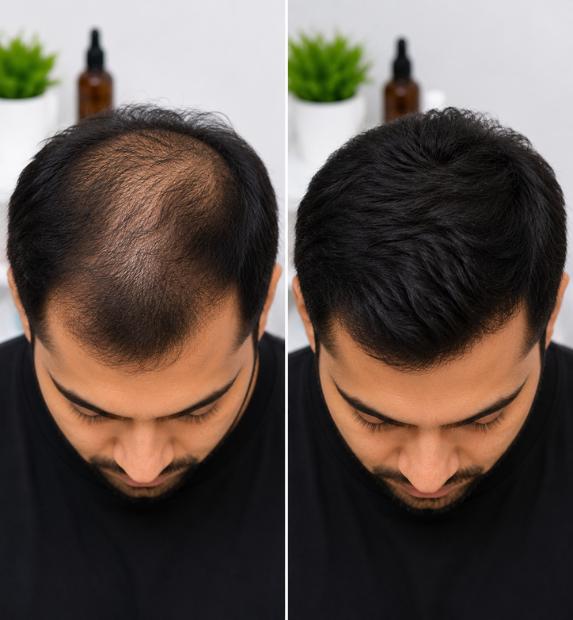 PRP Hair loss treatment results