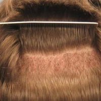 FUE(Follicular Unit Extraction)