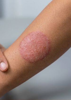 fungal infection treatment