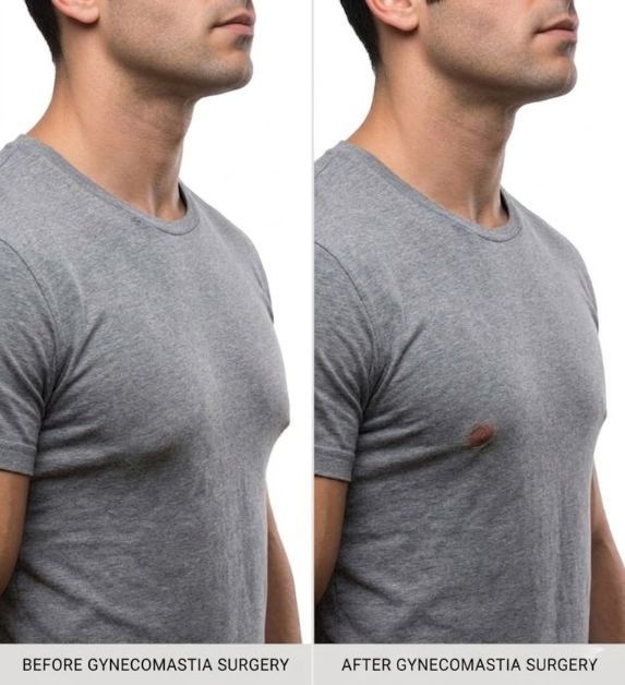 Gynecomastia -Treatment