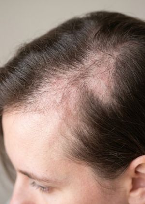 hair fall treatment
