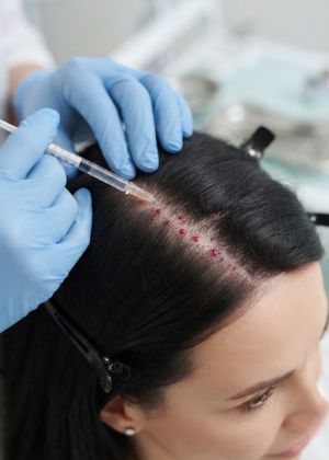 hair mesotherapy areas