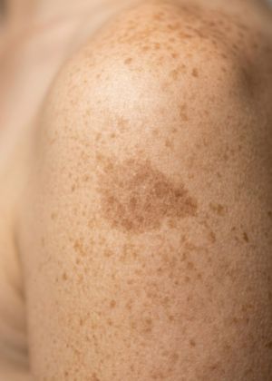 pigmented areas