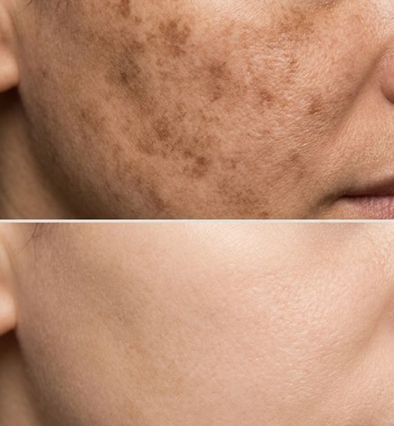 face hyperpigmentation