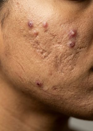 acne and scar areas