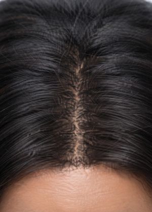 microneedling hair loss areas