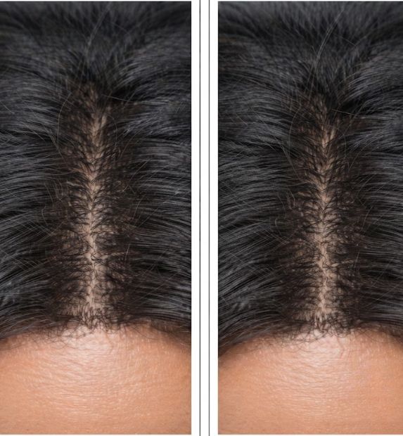 microneedling hair loss result