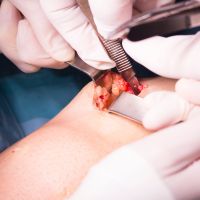 Micro Surgery Procedures