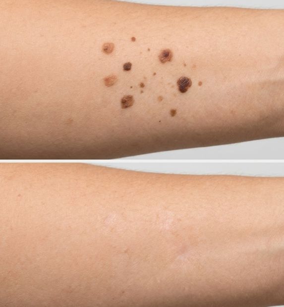 mole check