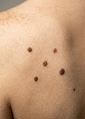 moles treatment areas