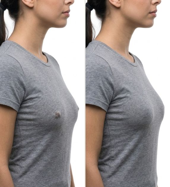 Inverted Nipple Correction Surgery