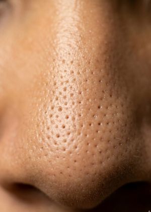 open pores areas