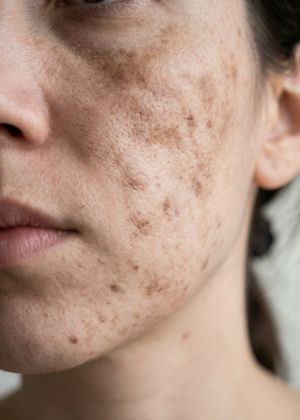 pigmentation treatment