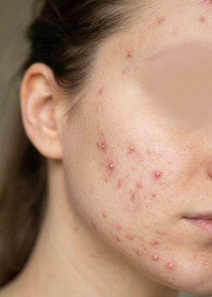 pimples treatment