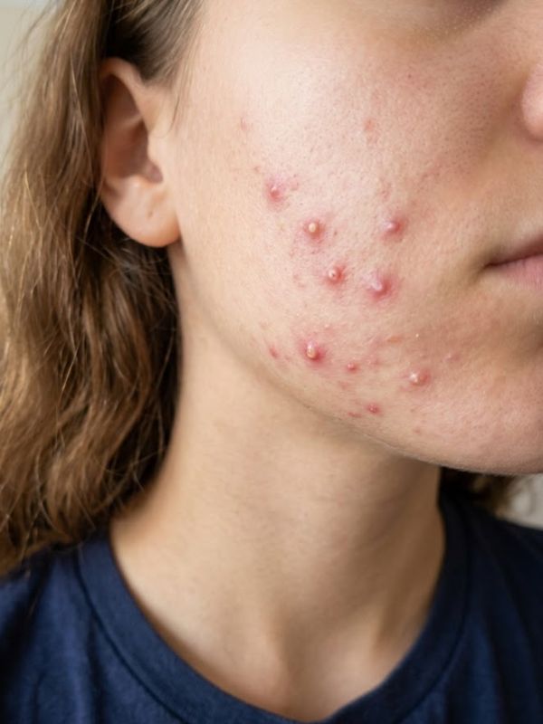 skin pimples treatment