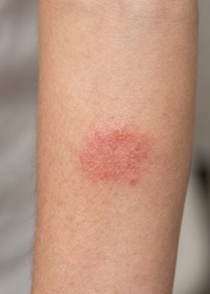 skin concern procedure
